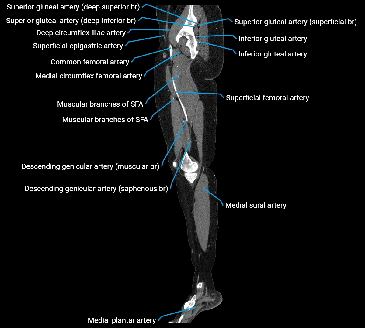 CTA lower limb sagittal cross sectional anatomy labelled image _30 (3).webp